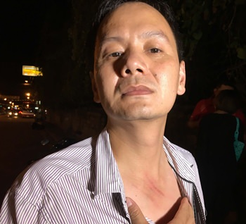 Zhu Tianming shows the scratches he received when a young thief snatched his gold necklace.