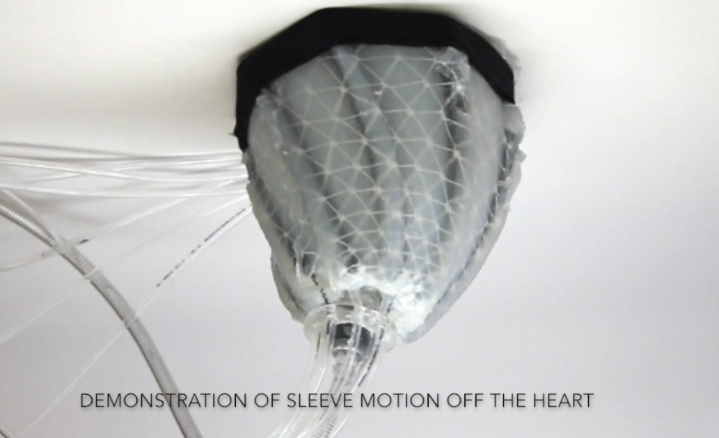 In this image from video, provided by Harvard University, a robotic sleeve designed to encase a diseased heart and gently squeeze it to help it better pump blood. Researchers at Harvard and Boston Children’s Hospital developed the experimental device in hopes of improving treatment of heart failure, when the heart becomes too weak to pump. (Ellen Roche/Science Translational Medicine via AP)