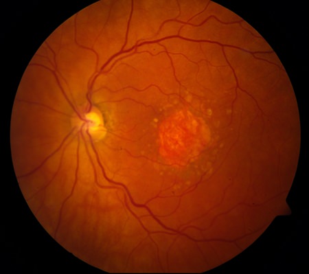 This image provided by the National Eye Institute shows a microscopic image of a retina being damaged by the so-called “dry” form of age-related macular degeneration. (National Eye Institute via AP)