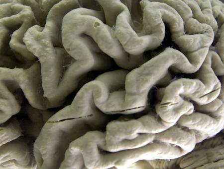 A section of a human brain with Alzheimer’s disease is on display at the Museum of Neuroanatomy at the University at Buffalo, in Buffalo, N.Y. (AP Photo/David Duprey, File)