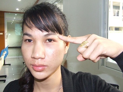 Nopparat Amphanan points to where two ladyboys gave him silicone injections that left him blind in one eye. 