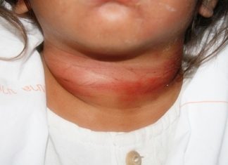 The little 2-year-old was left with major bruising from where a string had been tied around her neck.