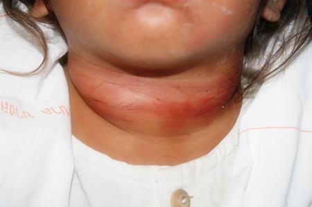 The little 2-year-old was left with major bruising from where a string had been tied around her neck. 
