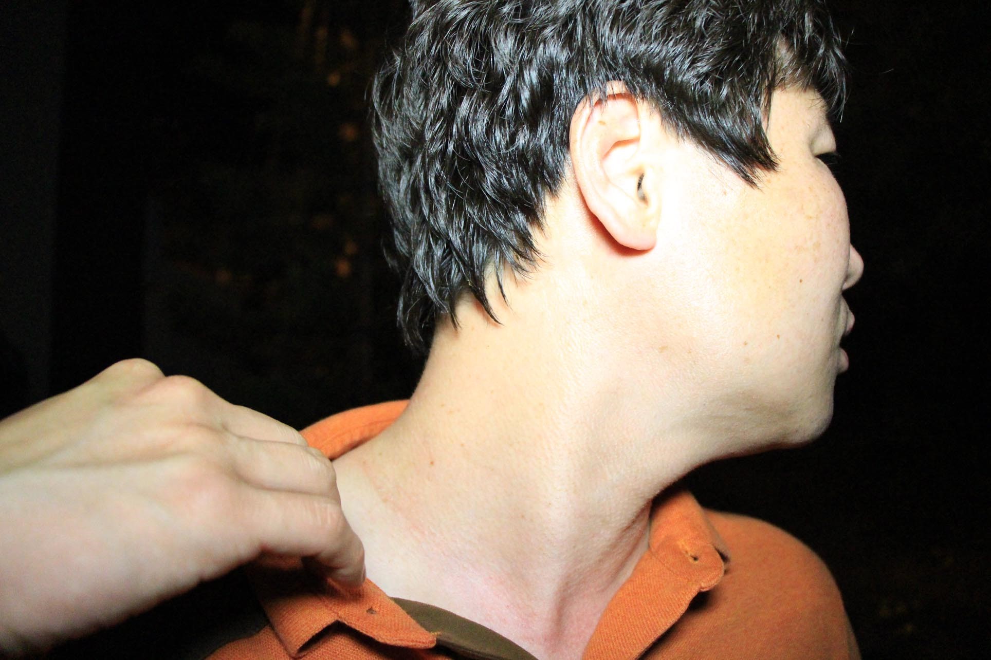 Kim shows off the bruise left after his expensive gold chain was snatched from his neck.