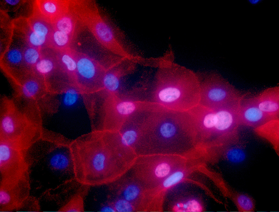 This fluorescence-colored microscope image shows a culture of human breast cancer cells. Environmental risks and heredity get the most blame for cancer, but new research released on Thursday, March 23, 2017 suggests random chance may play a bigger role than people realize. (Ewa Krawczyk/National Cancer Institute via AP)