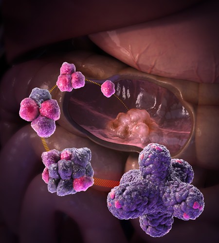 This illustration provided by the Hubrecht Institute in Utrecht, Netherlands shows organoids (mini organs), created from the intestinal tissues of a patient. (Hubrecht Institute via AP)