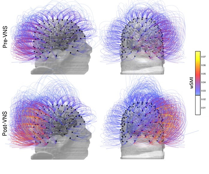 This image provided by the CNRS Marc Jeannerod Institute of Cognitive Science in Lyon, France, shows brain activity in a patient before, top row, and after vagus nerve stimulation. Warmer colors indicate an increase of connectivity. (CNRS Marc Jeannerod Institute of Cognitive Science, Lyon, France via AP)