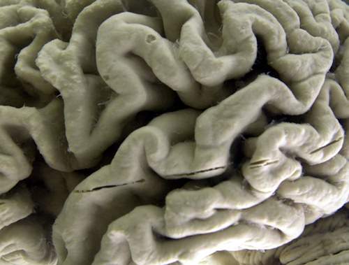 This Oct. 7, 2003 file photo shows a section of a human brain with Alzheimer's disease on display at the Museum of Neuroanatomy at the University at Buffalo, in Buffalo, N.Y. On Wednesday, July 25, 2018, two drug makers said an experimental therapy slowed mental decline by 30 percent in patients who got the highest dose in a mid-stage study, and it removed much of the sticky plaque gumming up their brains. The drug, called BAN2401, is from Eisai and Biogen. (AP Photo/David Duprey)
