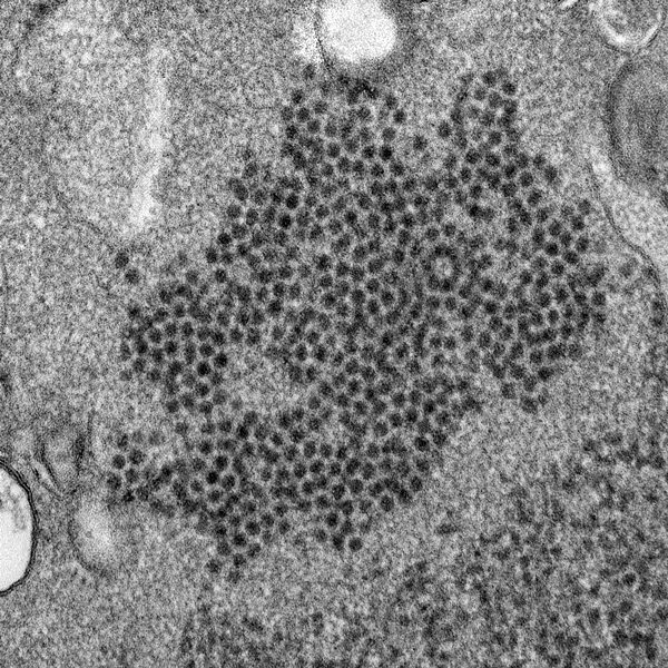 This 2014 file electron microscope image made available by the Centers for Disease Control and Prevention shows numerous, spheroid-shaped Enterovirus-D68 (EV-D68) virions. Doctors have suspected a mysterious paralyzing illness, acute flaccid myelitis, might be tied to the virus. (Cynthia S. Goldsmith, Yiting Zhang/CDC via AP, File)