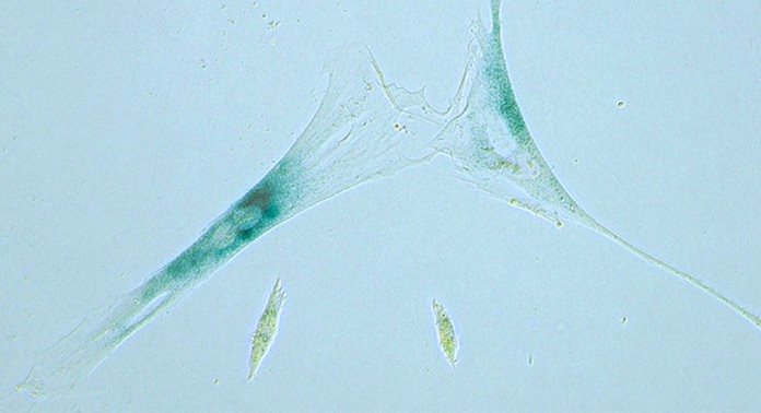 This microscope photo shows two senescent human fibroblast cells, above, next to normal cells. (Matthew Yousefzadeh, Mariah Witt/University of Minnesota via AP)