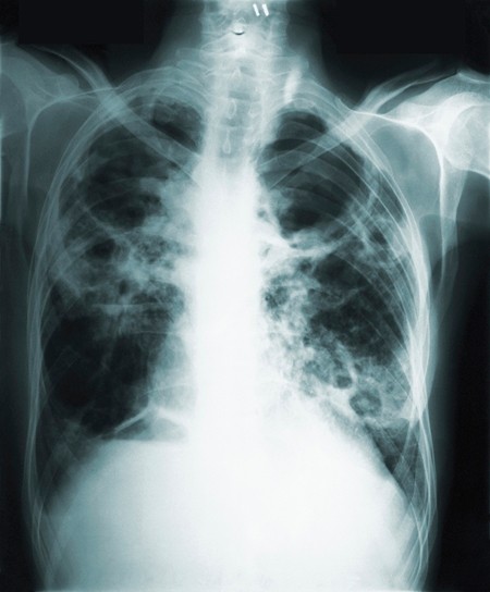 This 1966 image made available by the Centers of Disease Control and Prevention shows a chest x-ray of a tuberculosis patient. An experimental vaccine has proved 50% effective at preventing latent tuberculosis infection from turning into active disease in a three-year study of adults in Africa. (CDC via AP)