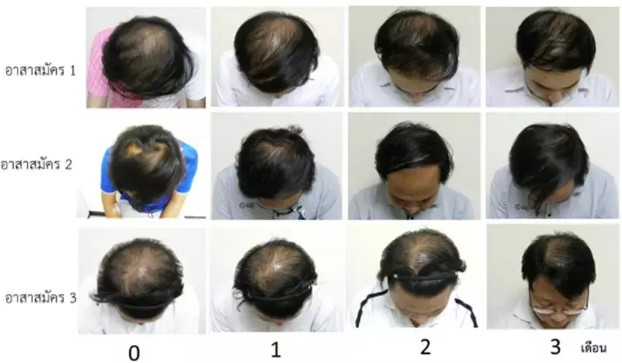 Thailand discovers way to treat hair loss with grey mangrove - Pattaya Mail