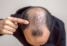 Hair Transplant in Bangkok for Hair Loss and Baldness