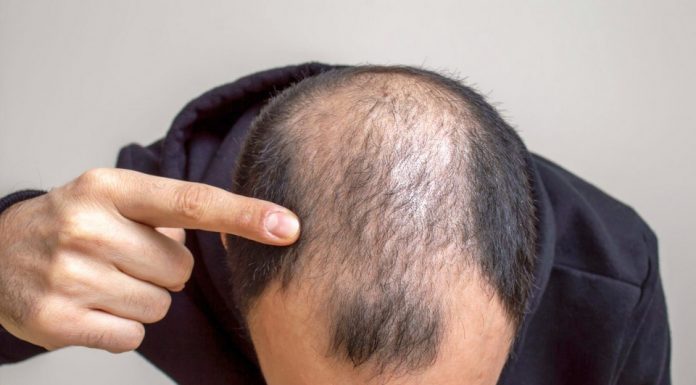 Hair Transplant in Bangkok for Hair Loss and Baldness