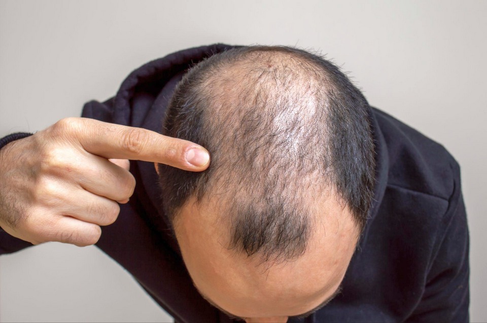 Hair Transplant in Bangkok for Hair Loss and Baldness