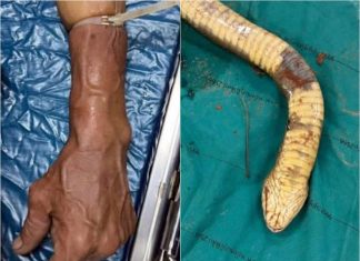 Thai doctors and influencers urge public to abandon dangerous snakebite tourniquet myth