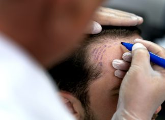 Hair Transplant in Thailand: What to Know Before Treatment