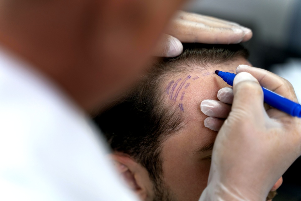 Hair Transplant in Thailand: What to Know Before Treatment