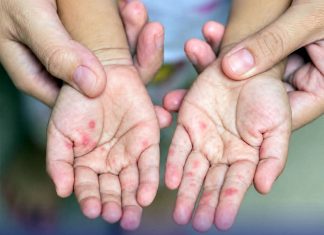 Thailand records 53,362 hand, foot and mouth disease cases this year