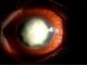 Motorbike rider nearly loses sight after insect sends fungal infection through cornea