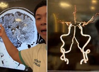 Difficulty recalling familiar names may signal a brain blood-flow problem